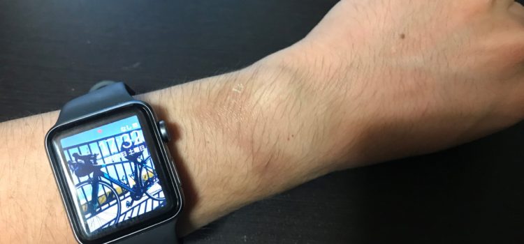 Apple Watchを毎日着けていて肌荒れ・肌焼けしてしまった場合の対処について
